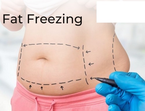 Fat Freezing: Remove Stubborn Fat