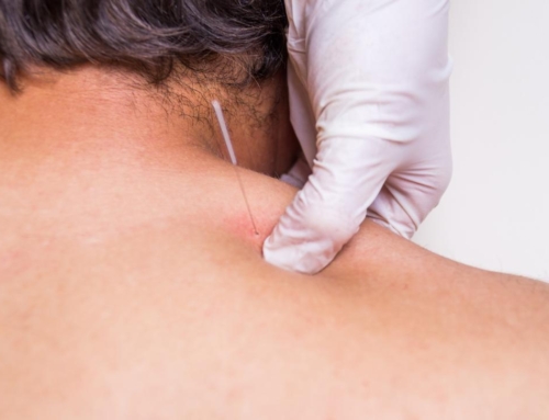 Trigger-point Dry Needling