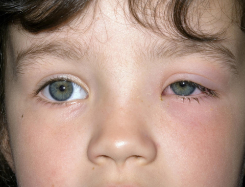 Conjunctivitis in children